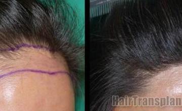 Hair transplant procedure before and after images