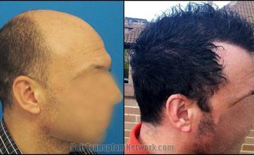 Hair transplantation surgery before and after images