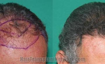 Hair transplantation surgery before and after pictures