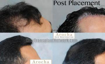 Hair restoration procedure before and after results