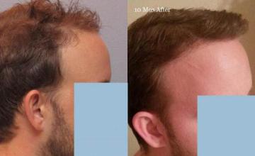 Hair transplantation surgery before and after images