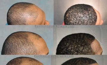 Hair restoration procedure before and after results