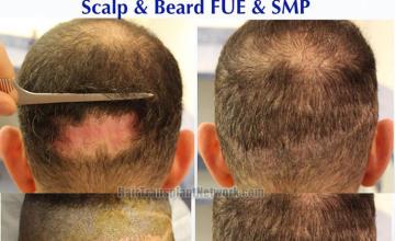 Hair transplantation procedure before and after photographs