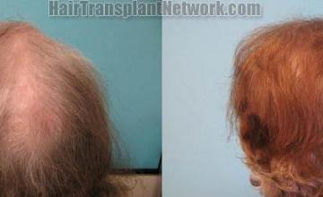 Hair restoration procedure before and after pictures