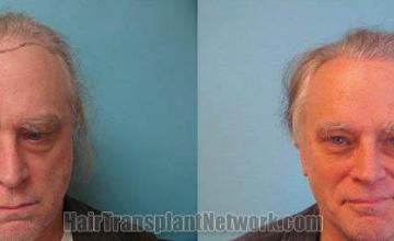 Hair restoration procedure before and after results