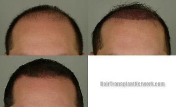 Hair transplantation surgery before and after images