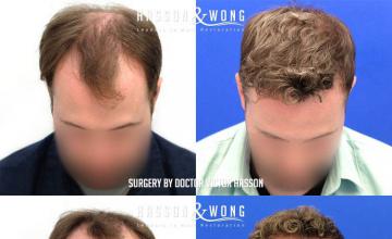 Front view - Before and after hair restoration procedure