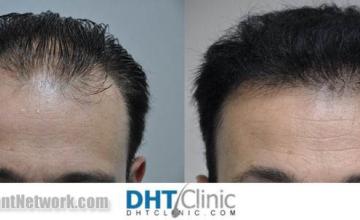 Before and after