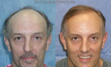 Hair restoration procedure before and after results