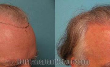 Hair transplantation surgery before and after images