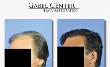 Hair transplantation surgery before and after pictures