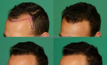 Hair transplantation surgery before and after pictures