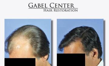 Hair transplant surgery before and after photos