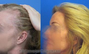 Hair transplantation surgery before and after images