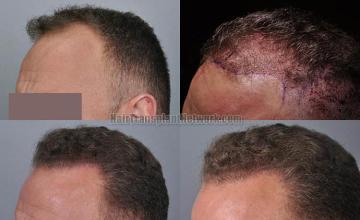 Hair transplantation surgery before and after pictures