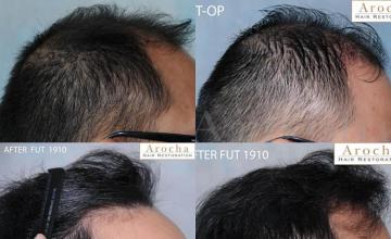 Hair transplantation surgery before and after photos