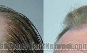 Hair transplantation surgery before and after images