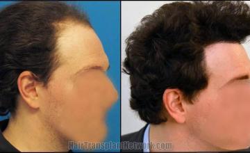 Hair restoration procedure before and after results