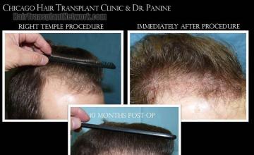 Hair transplantation surgery before and after images