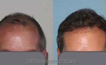 Front view - Before and after