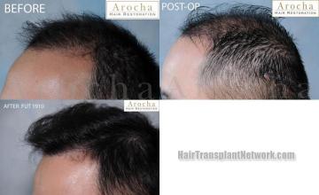 Hair transplantation surgery before and after images