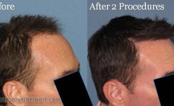 Photos showing before and after hair restoration results