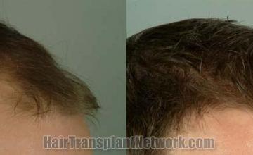 Before and after hair transplantation result photographs