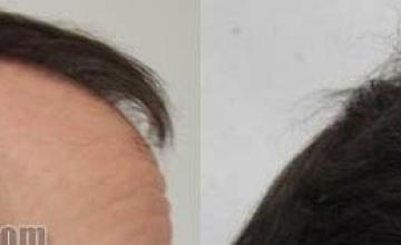 Hair transplantation surgery before and after images