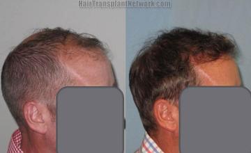 Hair transplantation surgery before and after images