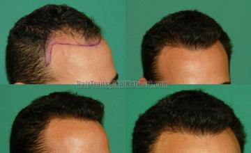 Hair transplantation surgery before and after images