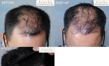 Hair transplantation surgery before and after photos