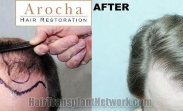 Top view before and after hair restoration results