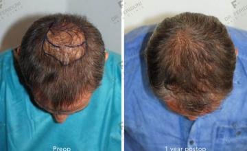 Hair restoration procedure before and after results