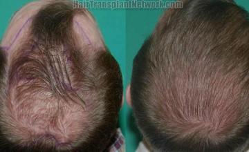 Hair restoration procedure before and after pictures