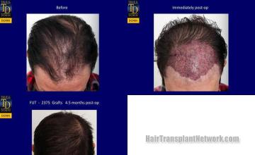 Hair transplantation surgery before and after photos