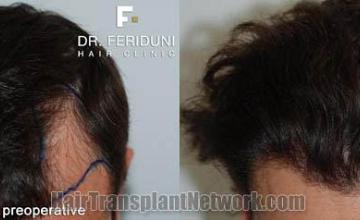 Hair transplantation surgery before and after photos