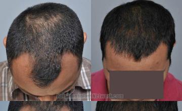 Hair transplantation surgery before and after photos