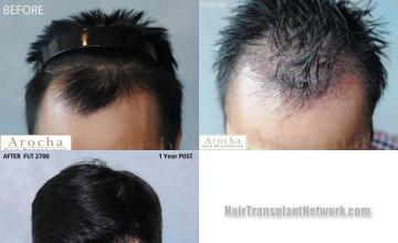 Hair transplantation surgery before and after photos