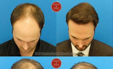 Top view - Before and after surgical hair replacement