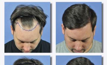 Hair transplantation surgery before and after photos