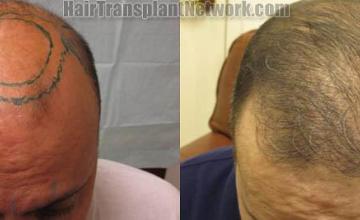 Top view before and after hair restoration results