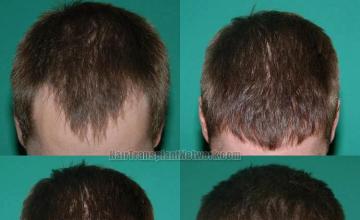 Hair transplantation surgery before and after pictures