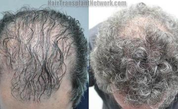 Top view before and after hair restoration results