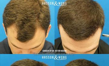 Hair transplantation surgery before and after photos