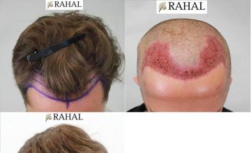 Before and after hair transplant procedure images