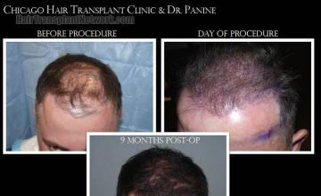 Hair restoration procedure before and after results