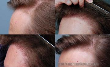 Hair transplantation surgery before and after images