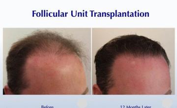 Hair transplantation procedure before and after results