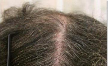 Hair restoration procedure results