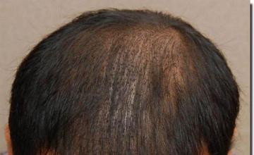 Hair restoration procedure results